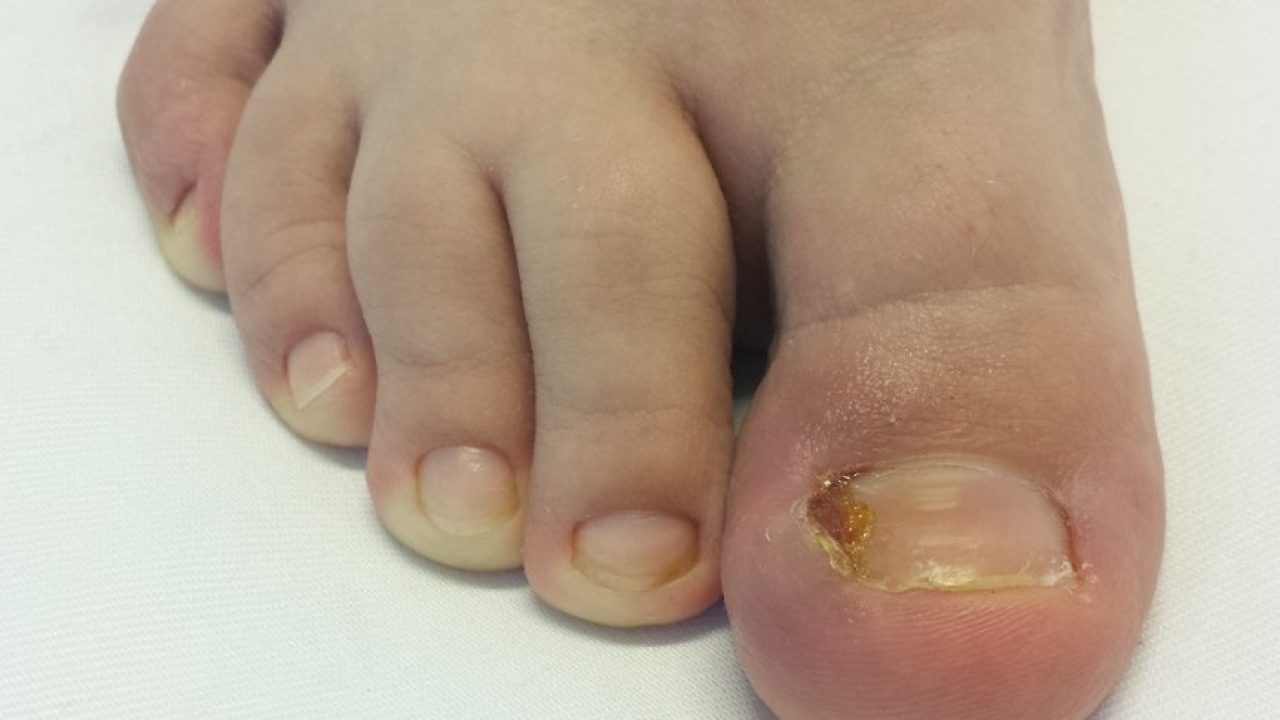 tratamentul artrozei de 1 deget de la picior