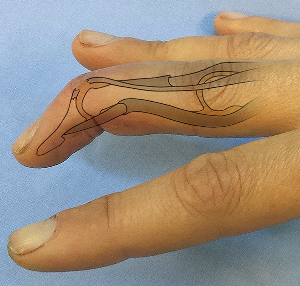 cum să tratezi o articulație a degetului rupt