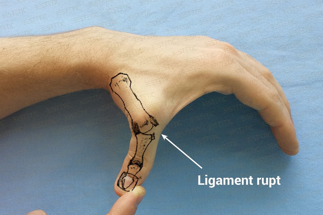 cum să tratezi o articulație ruptă pe deget