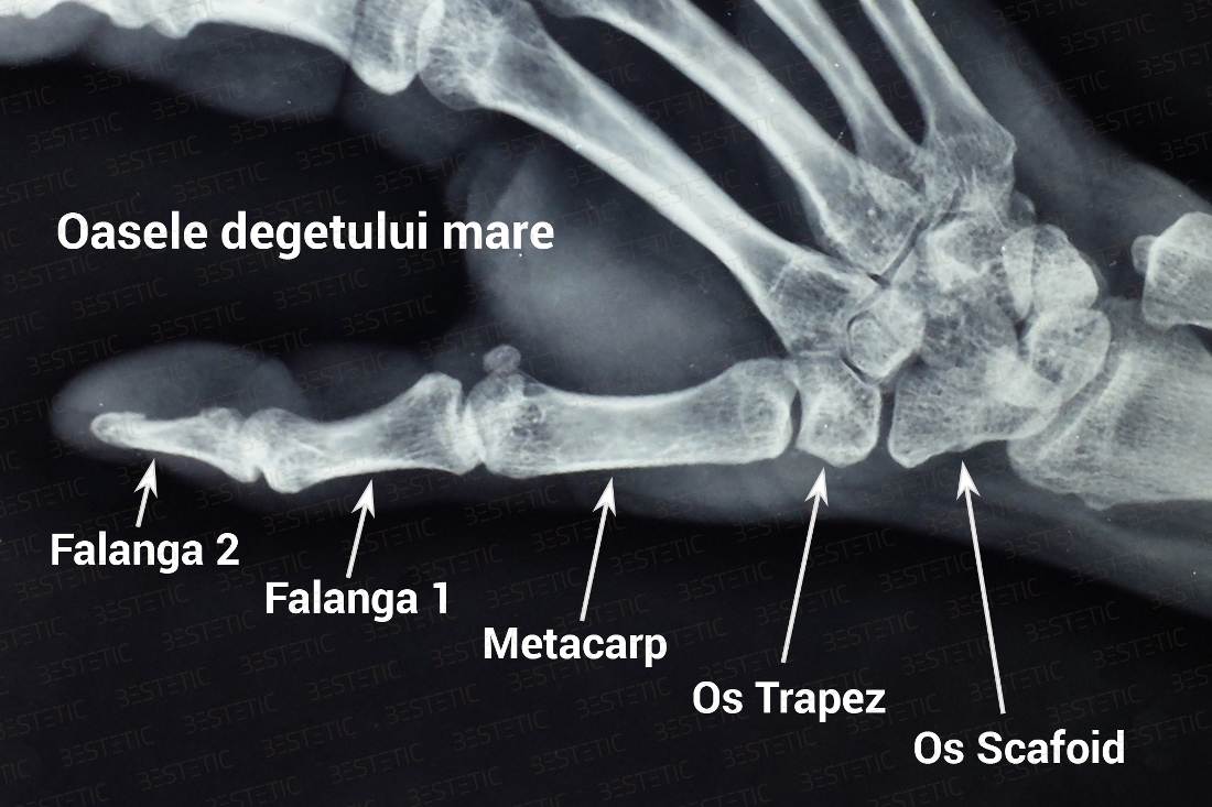 artroza articulațiilor mâinii și piciorului