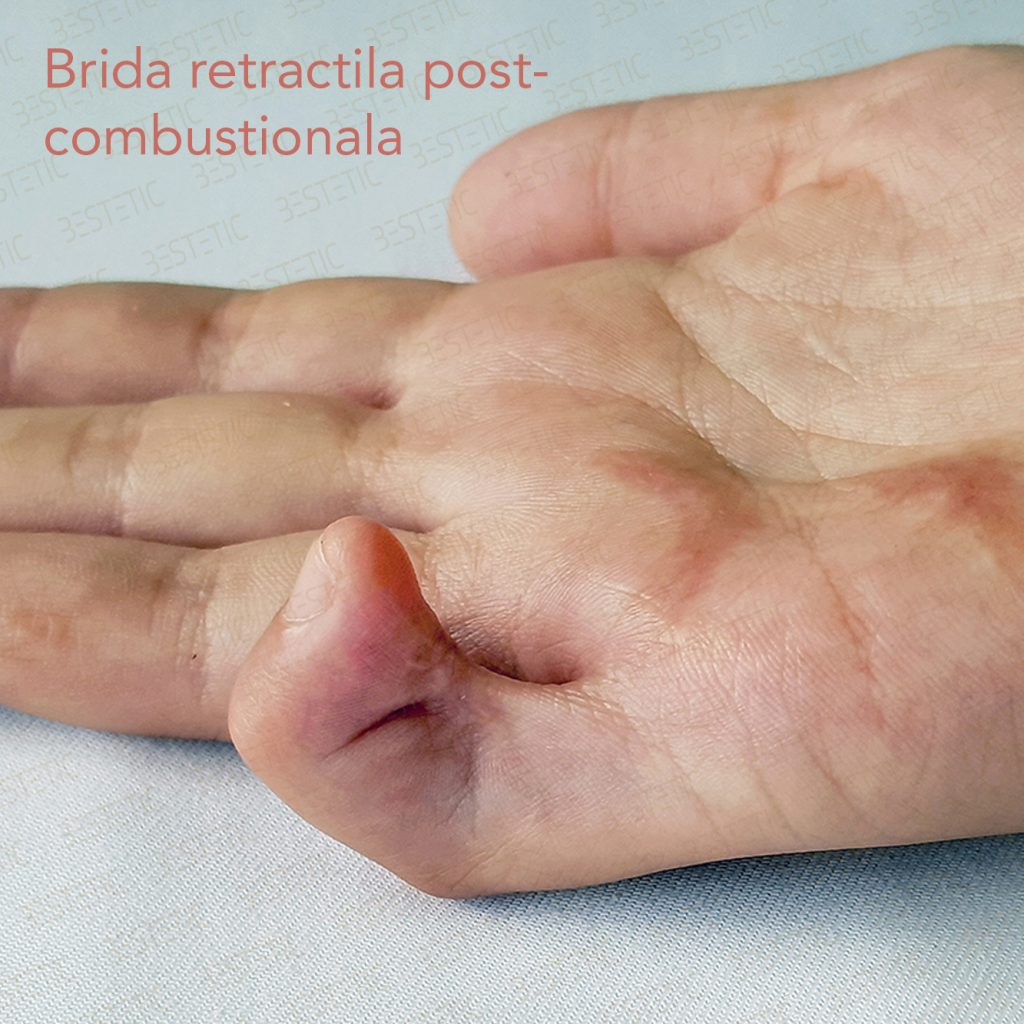 brida retractie deget dupa arsura postcombustional